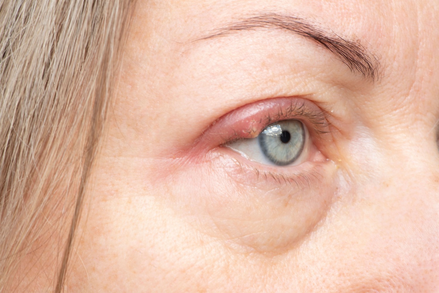 Primer plano de un ojo con un orzuelo en el párpado superior, mostrando enrojecimiento, inflamación y nódulo doloroso característico.