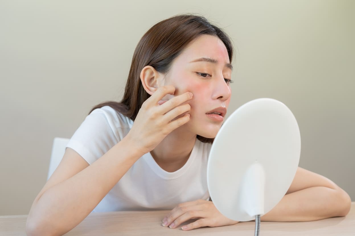 Mujer revisándose un brote de urticaria en el rostro mientras se mira preocupada al espejo