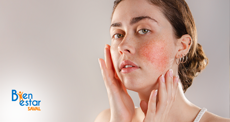 cuidados de la rosacea