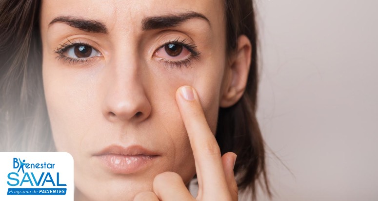 conjuntivitis que es sintomas y como evitar que se propague